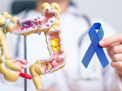 تشخیص زودهنگام سرطان روده بزرگ برای زنان بسیار مهم است